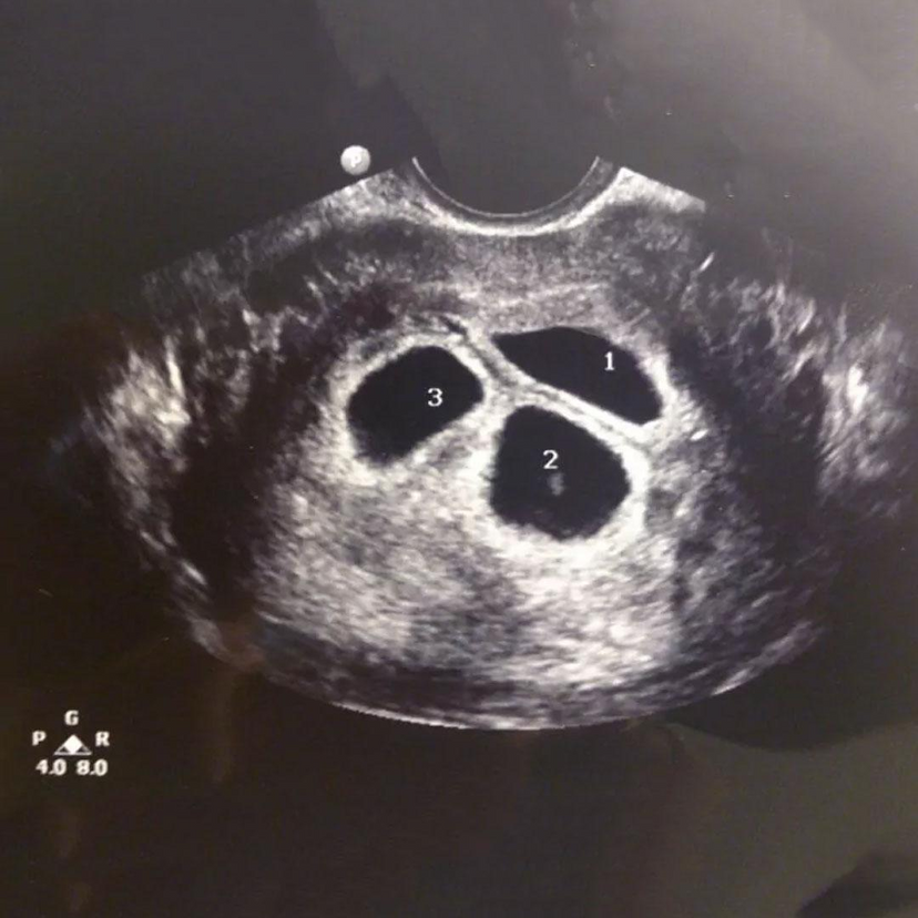 Fetal Reduction