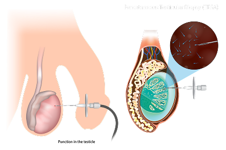 Surgical Sperm Retrieval