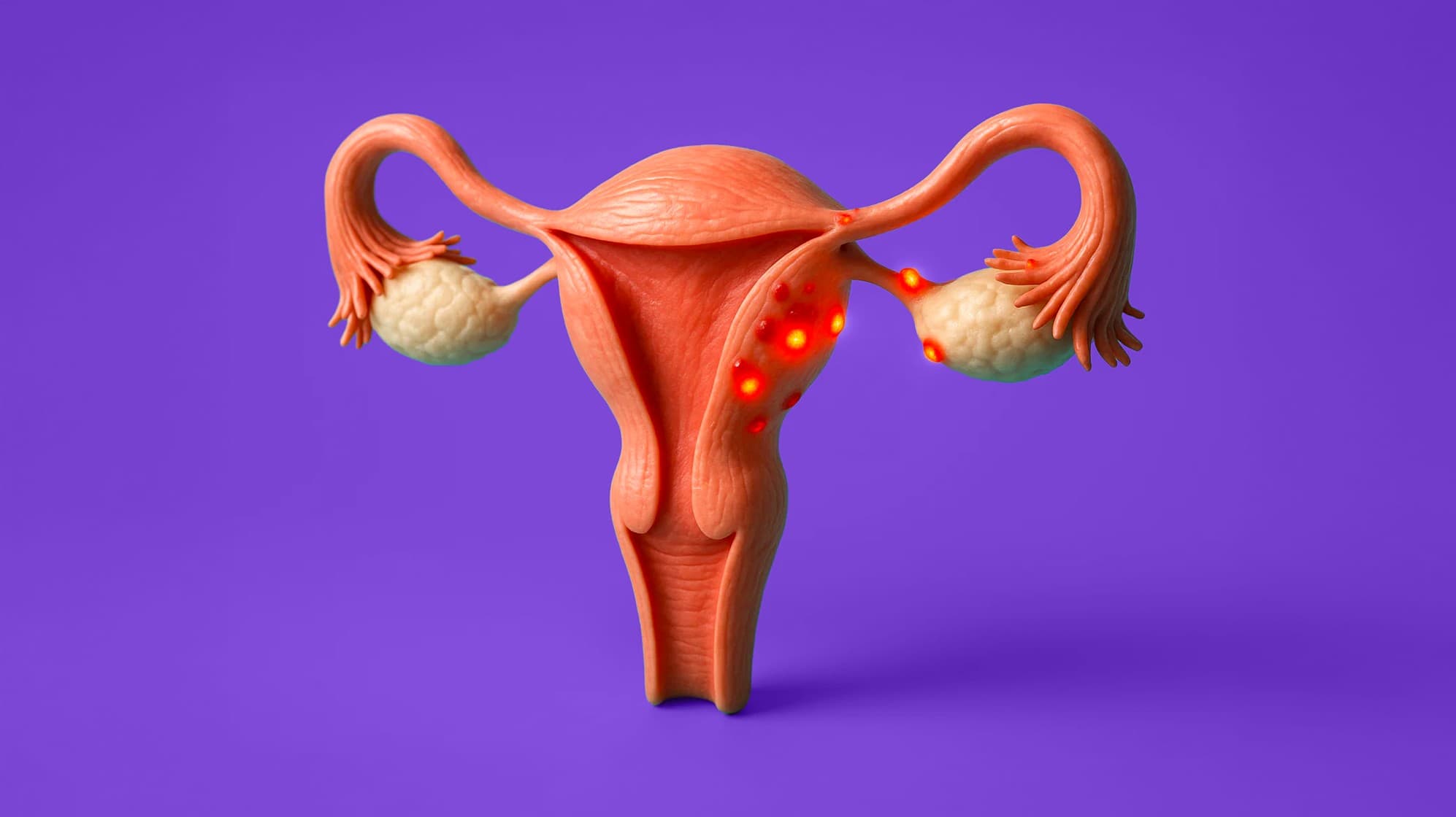 Endometriosis occurs when tissue grows outside the uterus, causing inflammation and potentially affecting fertility.