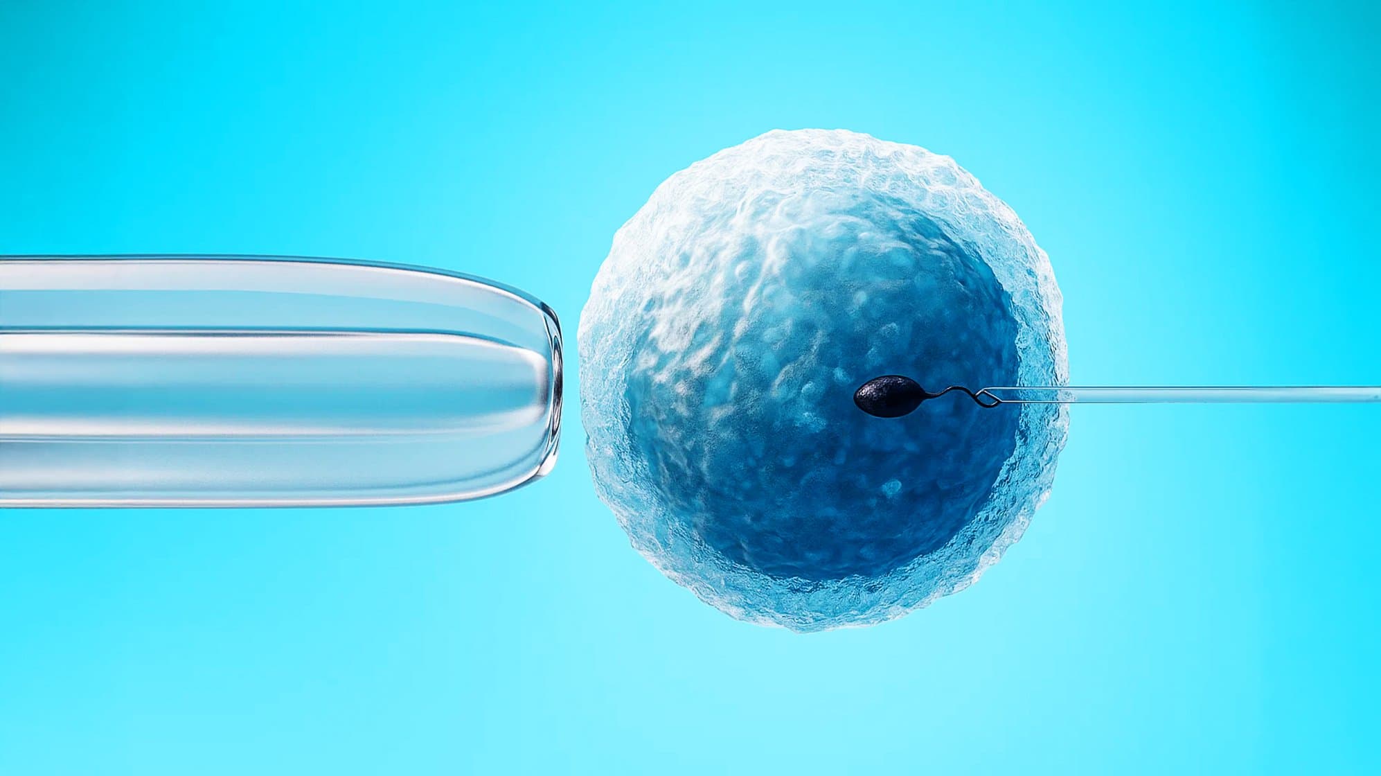 3D medical illustration of ICSI treatment showing a single sperm being injected into an egg with a microneedle during assisted fertilization in IVF