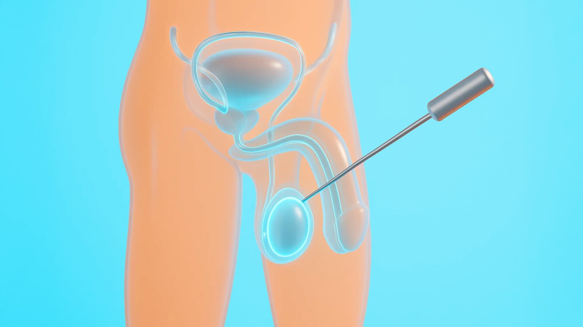Surgical Sperm Retrieval: Making Parenthood Possible